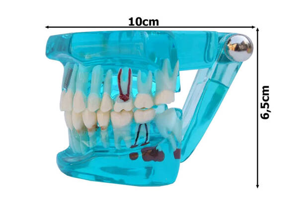 Zubní model čelist zuby zubní implantáty