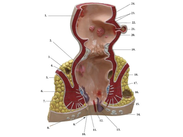 Anatomical model of anus hemorrhoids magnification 5x