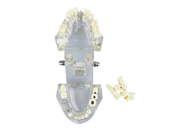 Dental model jaw teeth teeth implants