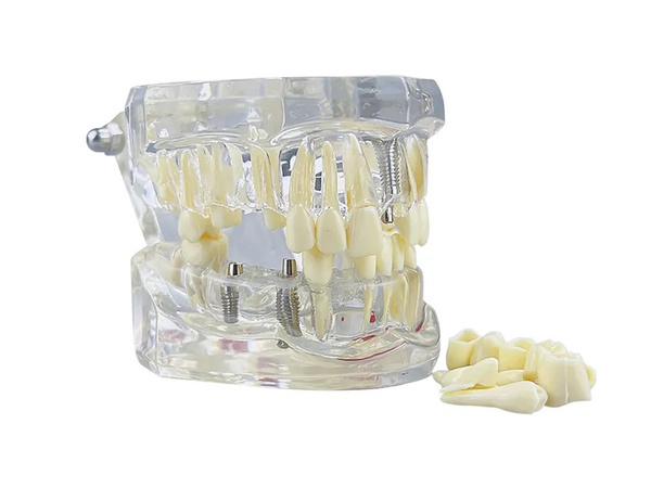 Dental model jaw teeth teeth implants