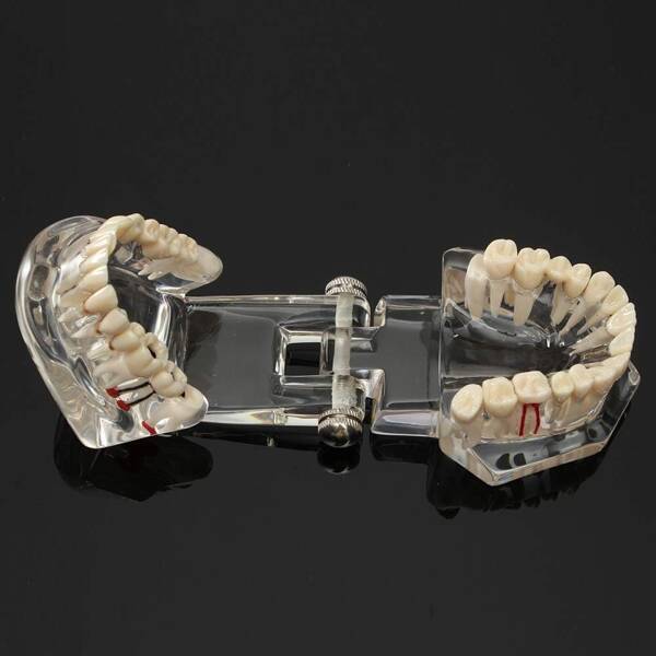 Dental model jaw teeth teeth implants