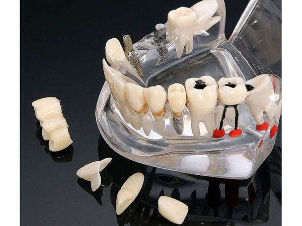 Dental model jaw teeth teeth implants