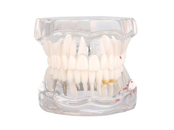 Dental model jaw teeth teeth implants