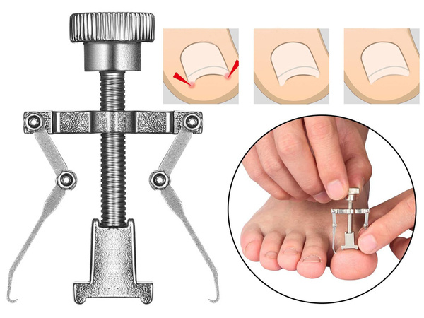 Ingrown toenail kit toenail and hand nail clippers