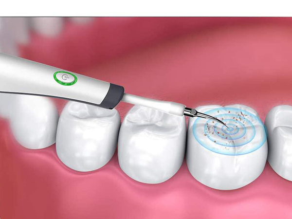 Ultrasonic dental scaler for calculus