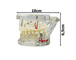 Dental model jaw teeth teeth implants