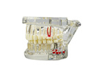 Dental model jaw teeth teeth implants