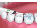 Ultrasonic dental scaler for calculus