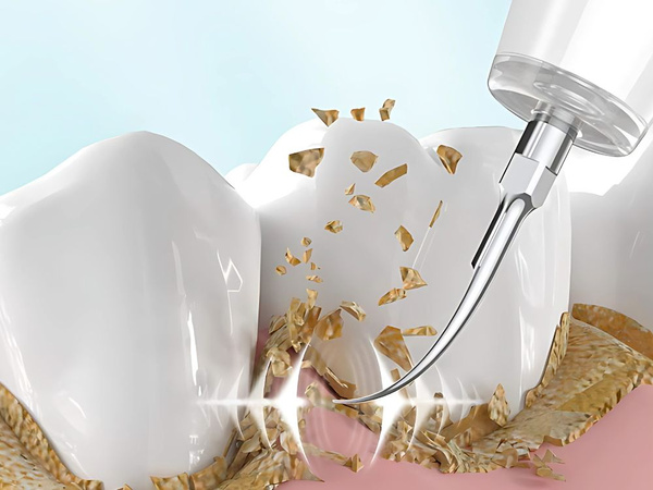 Ultrazvukový zubný skalér na čistenie zubov, odstraňovanie zubného kameňa