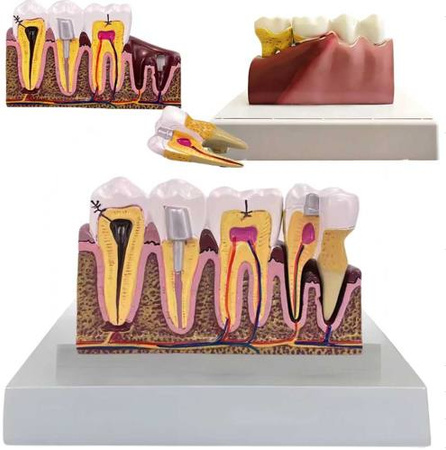 Anatomical model of a dental tooth educational cross-section removable tooth