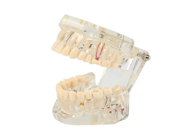 Zubný model čeľuste zuby zubné implantáty