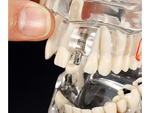 Modèle dentaire dents de la mâchoire implants dentaires