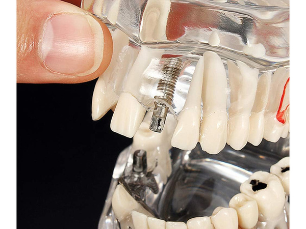 Dental model jaw teeth teeth implants