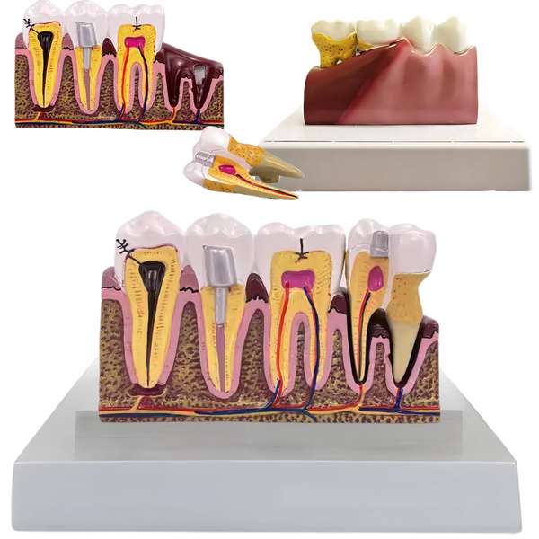 Anatomical model of a dental tooth educational cross-section removable tooth