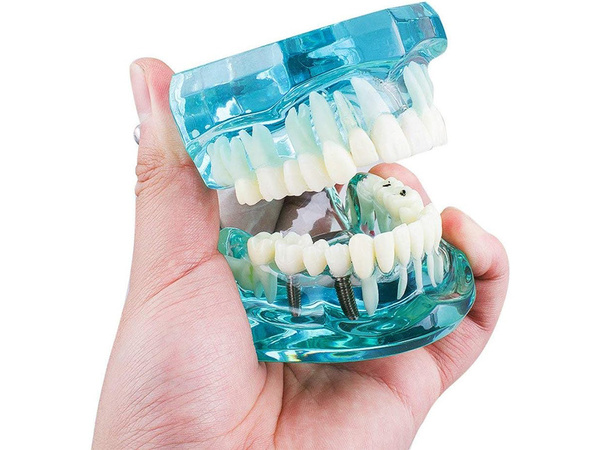 Dental model jaw teeth teeth implants