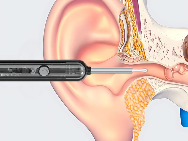 Endoscope otoscope avec camera wifi pour le nettoyage des oreilles outils smart kit