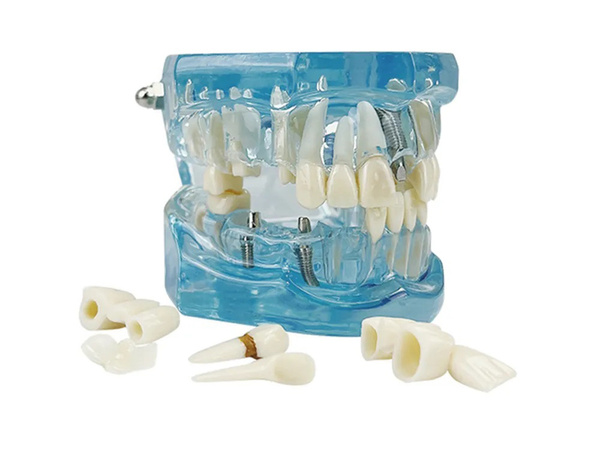 Modèle dentaire dents de la mâchoire implants dentaires