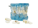 Dental model jaw teeth teeth implants
