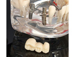 Dental model jaw teeth teeth implants