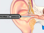 Endoscope otoscope avec camera wifi pour le nettoyage des oreilles outils smart kit