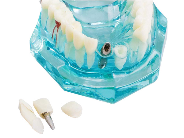 Dental model jaw teeth teeth implants